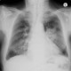 Pulmonary infiltrates, pleural effusion: X-ray - Plain radiograph
